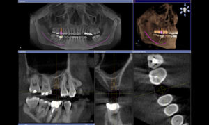 Actual Patient CT Scan