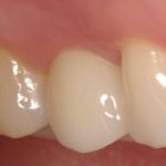 Dental Implant