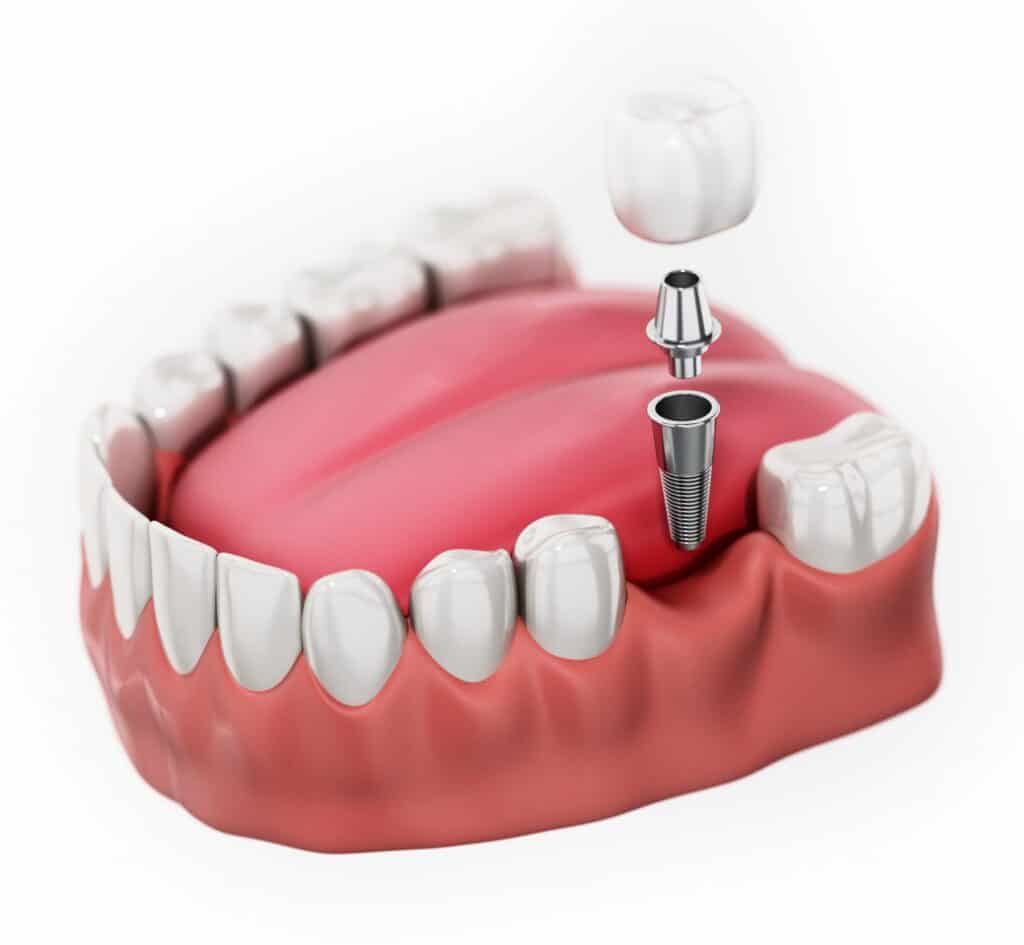 dental implant dentist near me in Arizona