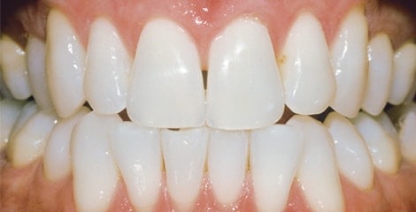 Teeth Whitening After