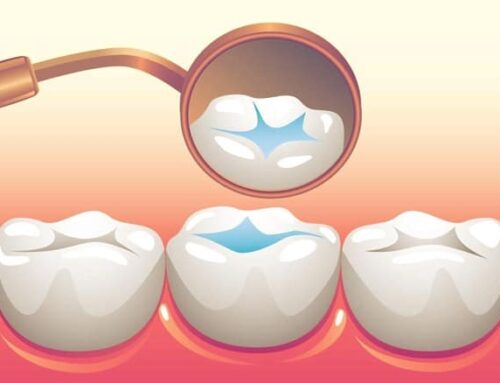 Dental Sealants Provide Protection by Maintaining Good Oral Health