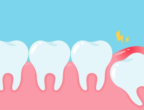 What You Should Know About Impacted Wisdom Teeth