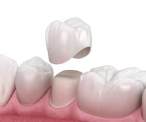 Dental Tooth Crown