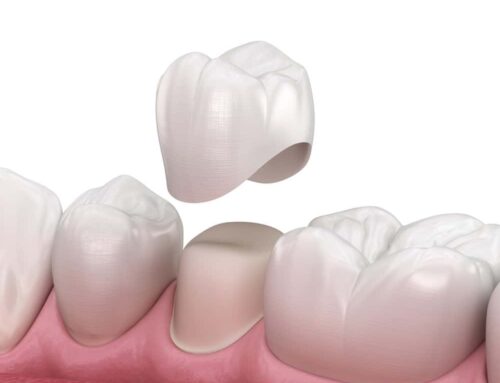 Affordable Dental Crowns are now available in Chandler, AZ