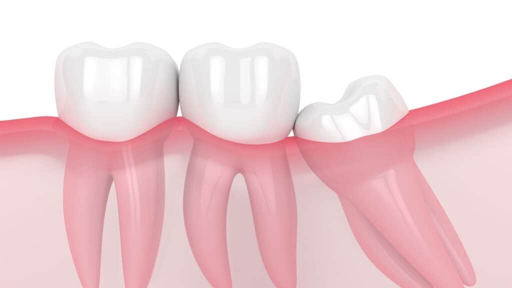 Wisdom Tooth Graphic