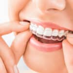Invisalign clear braces Invisalign clear braces