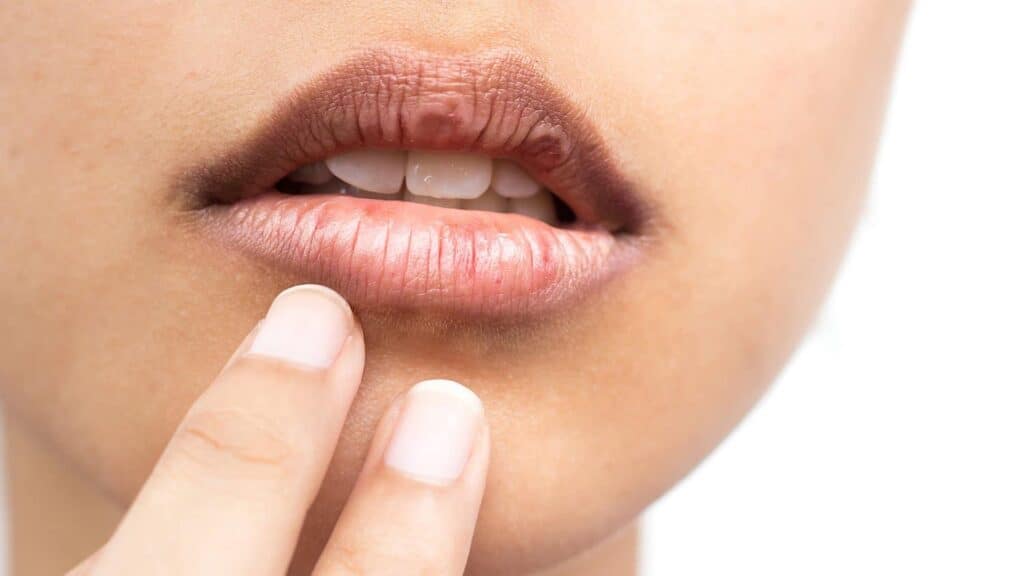 Dry Mouth