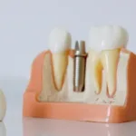 dental crown near me