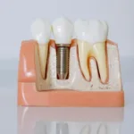 dental implants cut out